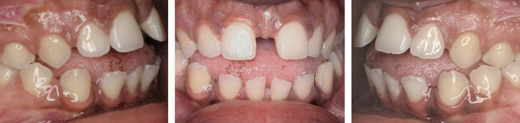 invisalign_2_short_before